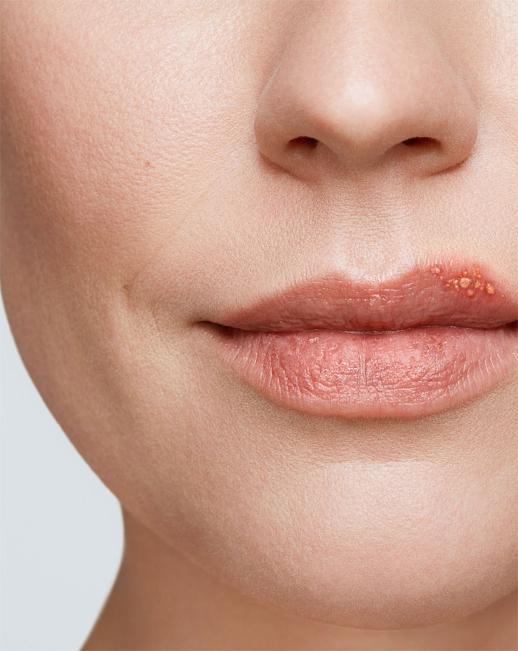 Cold Sore Stages Get Rid Of A Cold Sore Abreva sore-throat-treatment